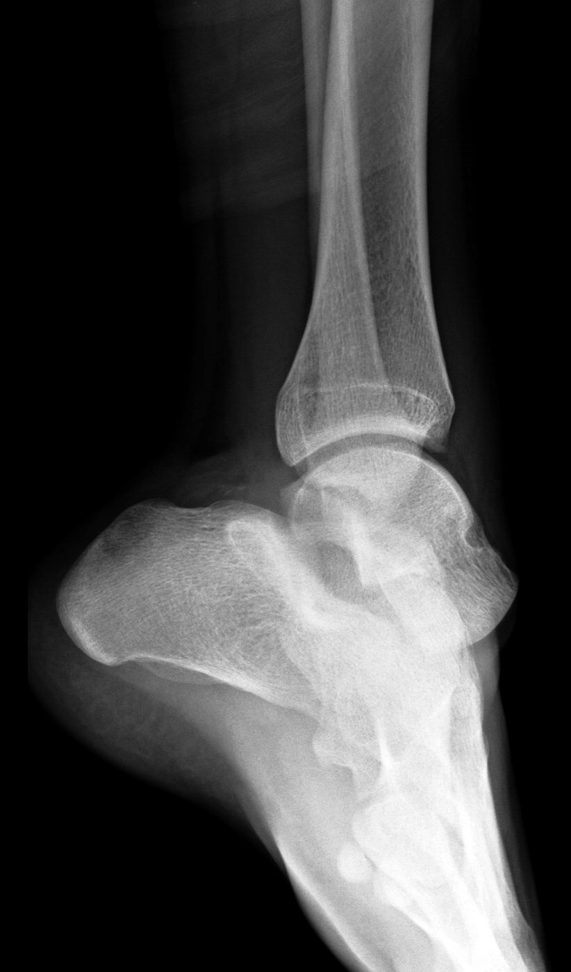 Figure 1 for case Medial subtalar joint dislocation( RID3029 )